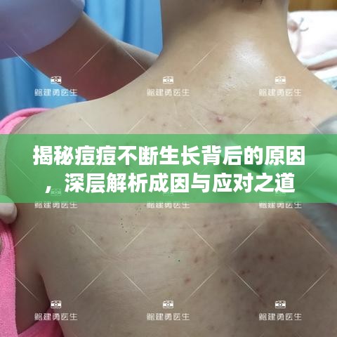 揭秘痘痘不斷生長(zhǎng)背后的原因，深層解析成因與應(yīng)對(duì)之道